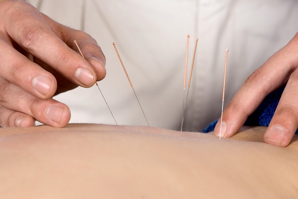 5 Best Acupuncture in Birmingham